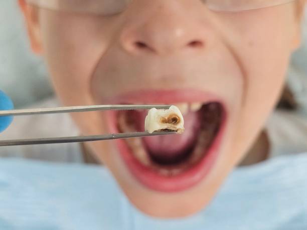 Best Knocked-Out Tooth (Avulsed Tooth) Treatment in Oak Island, NC